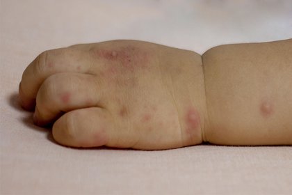Hand, foot and mouth disease spots on a baby's hand and wrist on white skin. A long description is available next.